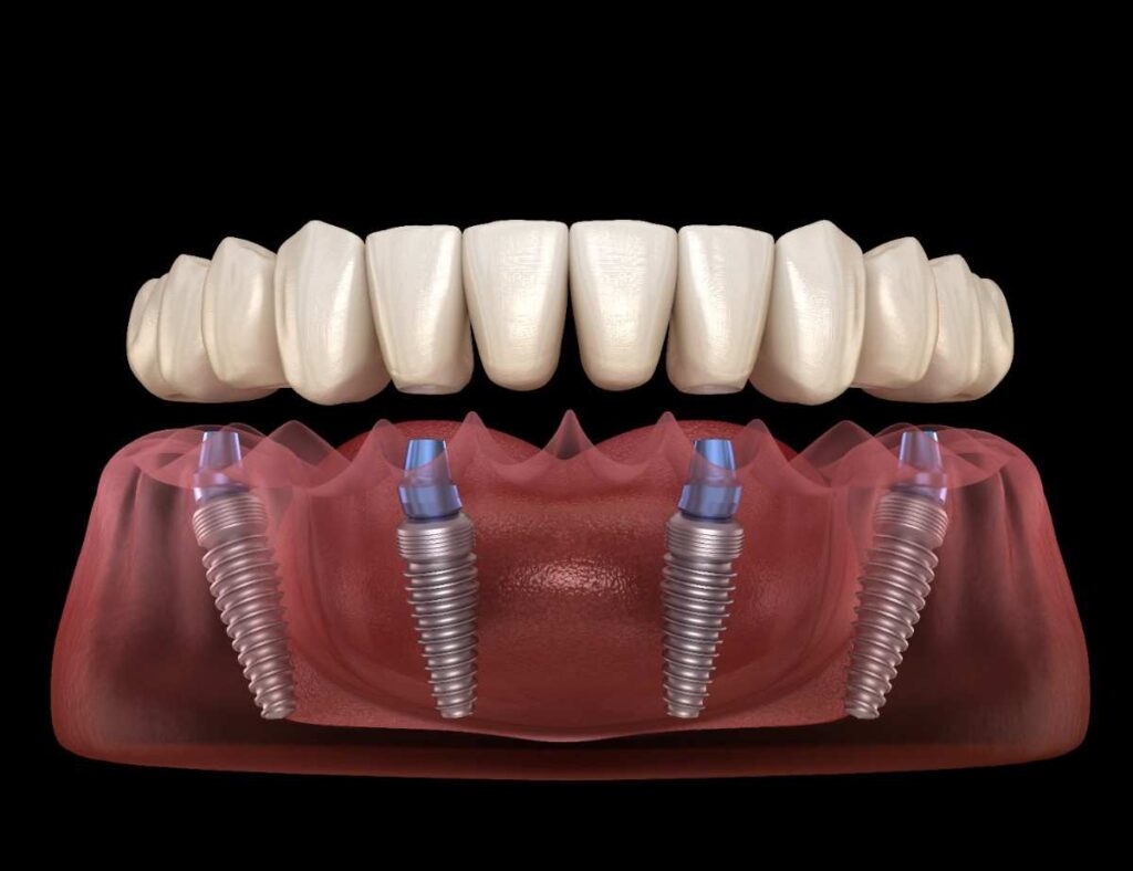 Cleaning All-on-4 Implants: Preventing Food Debris