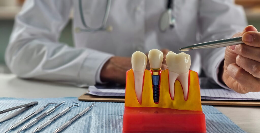 How to Clean Dental Implants?
