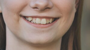 What Happens When You Stop Ignoring Crooked Teeth?